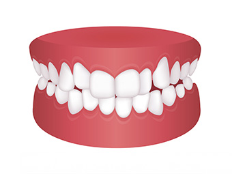 Orthodontic issues - Early Treatment in Lander & Riverton WY - Olsen Orthodontics